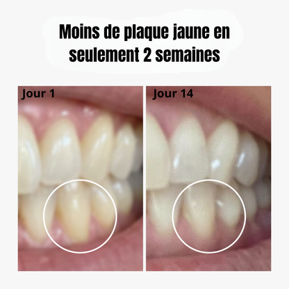 Sorriso SonicPro X1 | Brosse à Dents Sonique — Dents Blanches en 14 Jours.