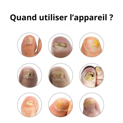 Orthovital Pro™ – Appareil LED pour le soin des ongles à domicile