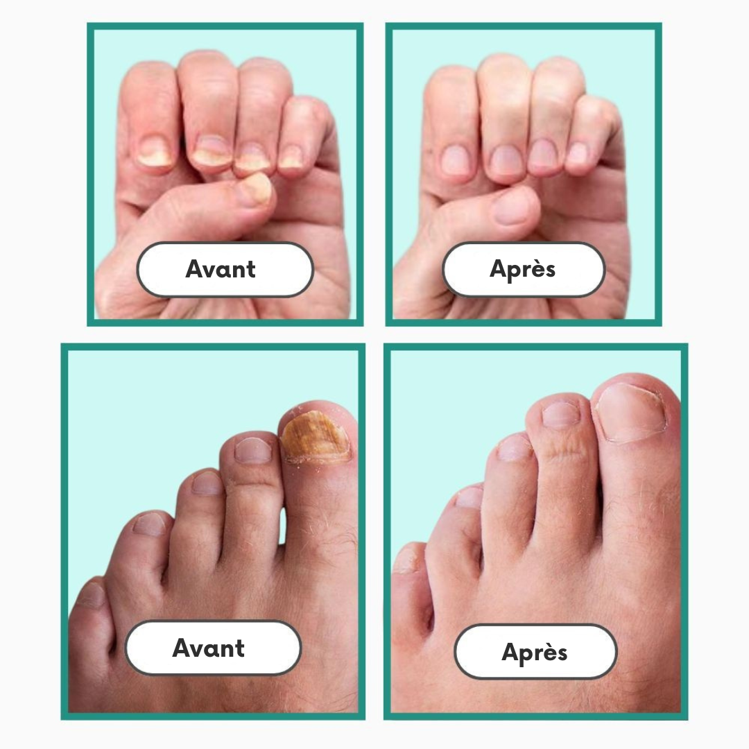 Orthovital Pro™ – Appareil LED pour le soin des ongles à domicile